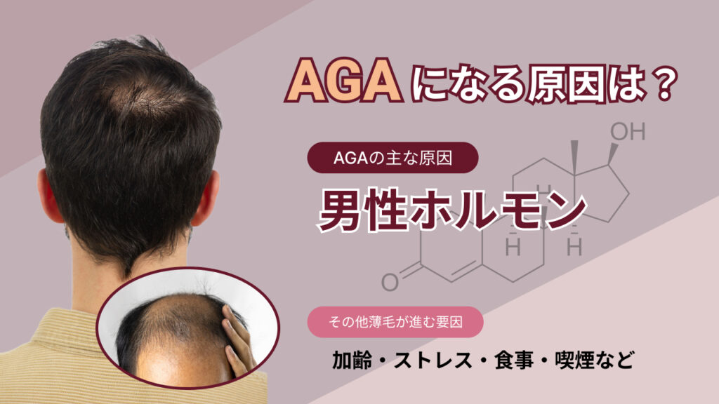 AGAの原因画像