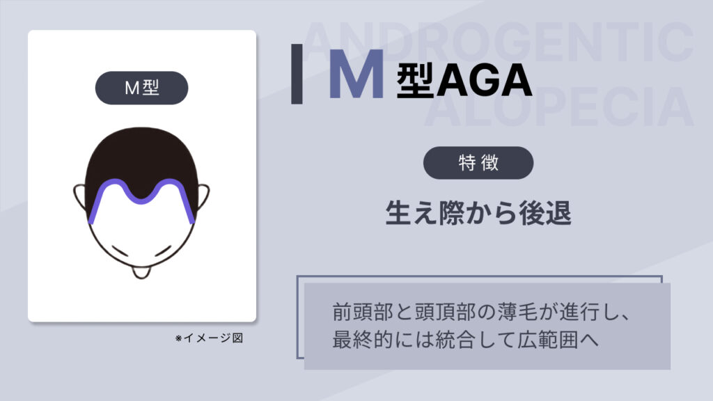 M型AGAの画像