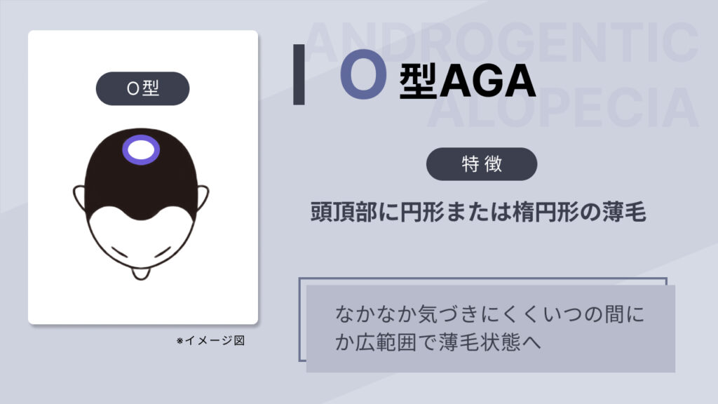 O型AGAの画像