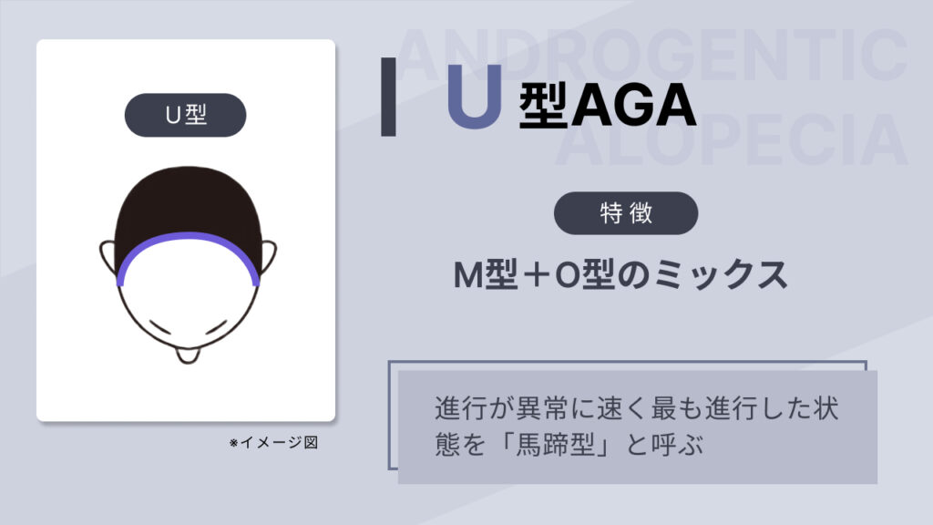 U型AGAの画像