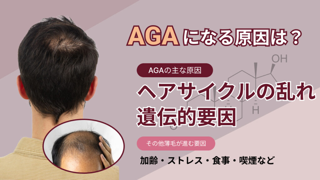 AGAの原因